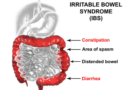 IBS - What Is It & How to Manage It