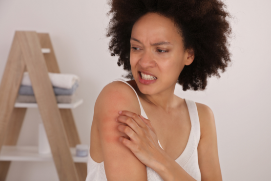 How to Manage Your Eczema?