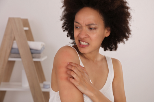 How to Manage Your Eczema?